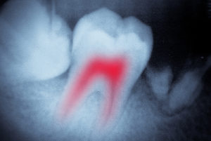 root canal