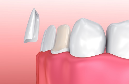 dental veneers