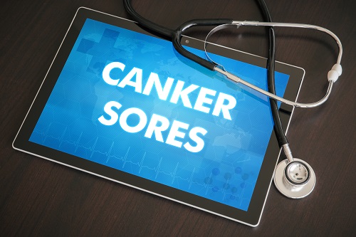 canker sore