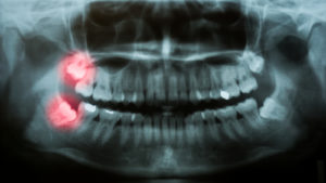 wisdom teeth on x-ray