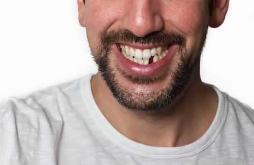 man missing tooth