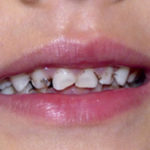 What causes Baby Bottle Tooth Decay?