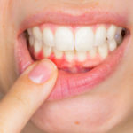 What Causes Receding Gums?