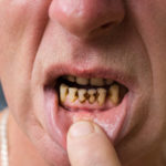 Meth Mouth: How Methamphetamine Use Affects Dental Health