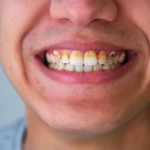 Methamphetamine Affected Teeth